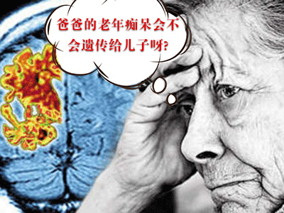 老年癡呆癥會(huì )不會(huì )遺傳?