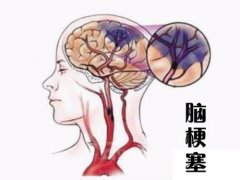 養成好的生活習慣，能夠有效預防腦梗塞